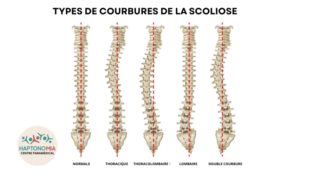 Types de courbures de la scoliose