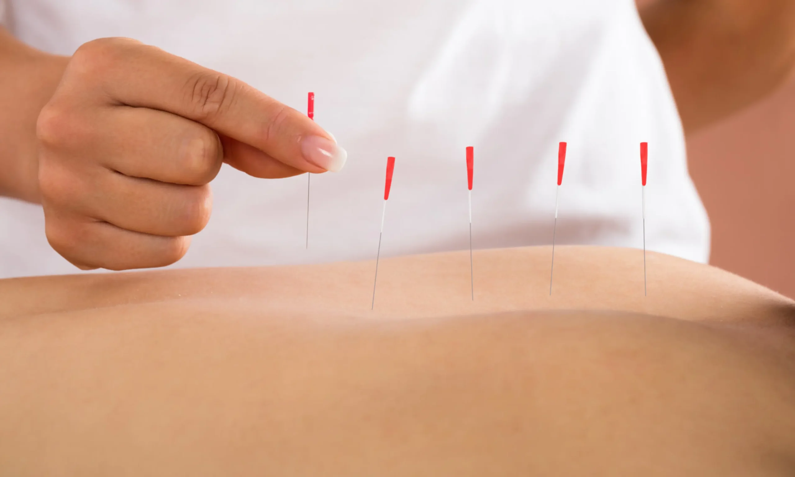 Séance de Dry Needling