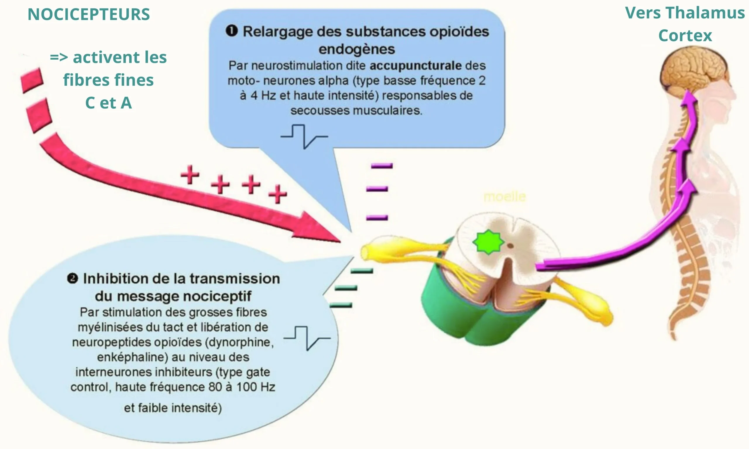 Comment fonctionne l'électrothérapie