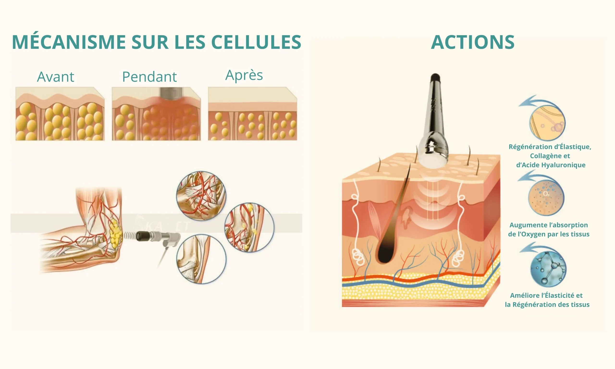 Les mécanismes de l'Ultrasons